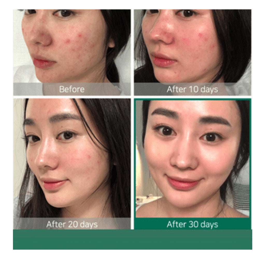 AHA 30% + BHA 2% Peeling Solution